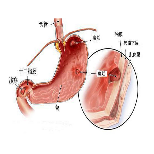 石家庄胃炎