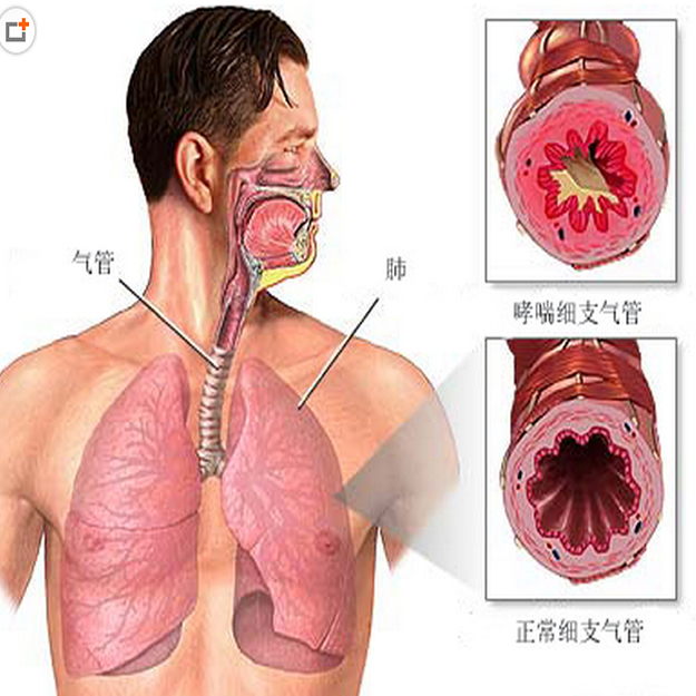 石家庄过敏性哮喘