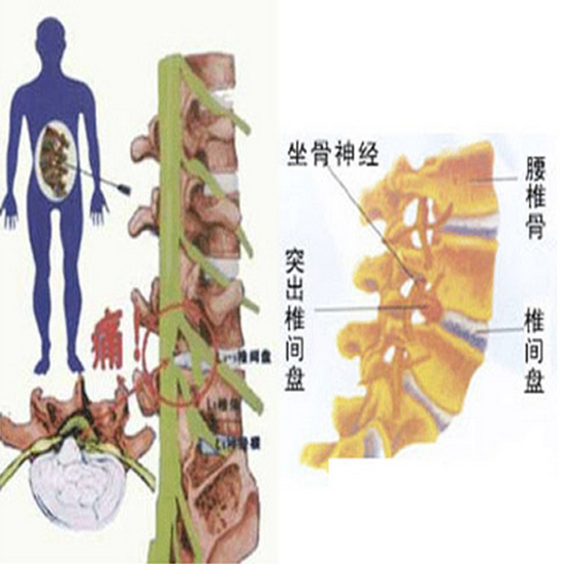 腰间盘突出